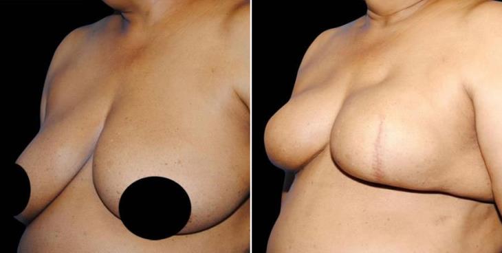 Breast Reconstruction Before & After Side View