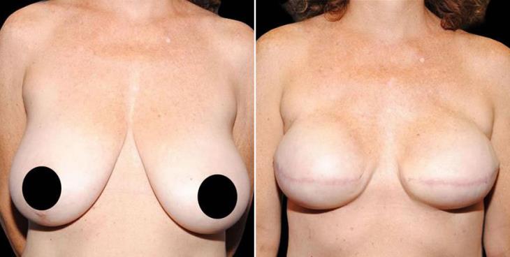 Before & After Breast Reconstruction