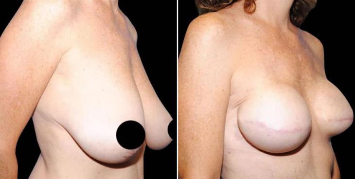 Before & After Breast Reconstruction Side View