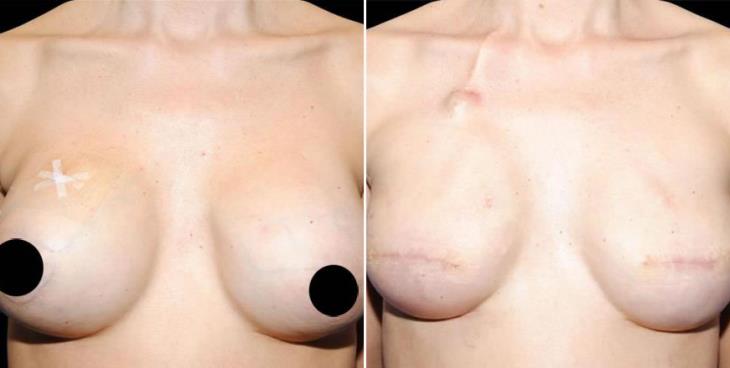 Before & After Breast Reconstruction Atlanta