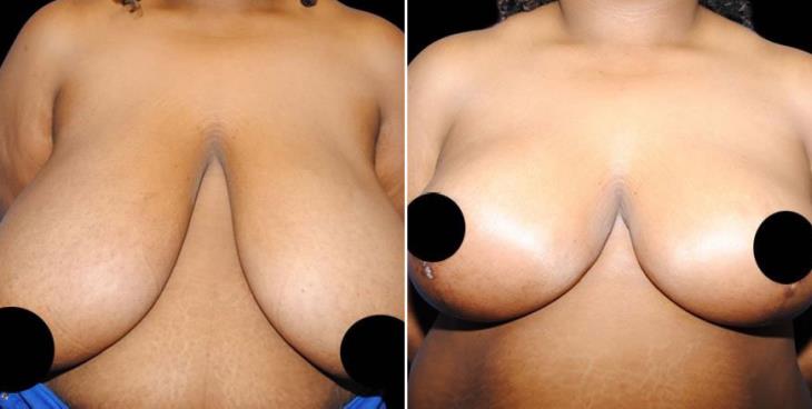 Before And After Breast Reduction