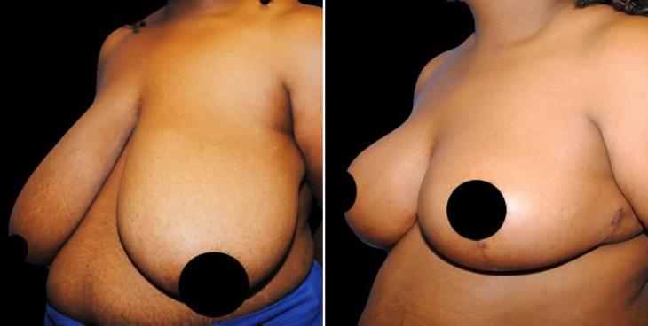 Before And After Breast Reduction Side View