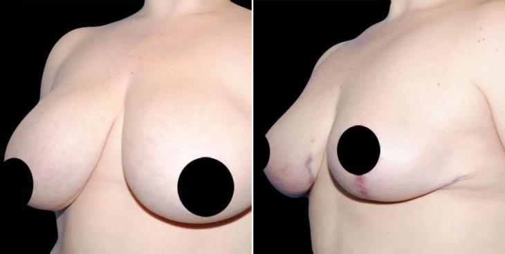 Breast Reduction Before And After