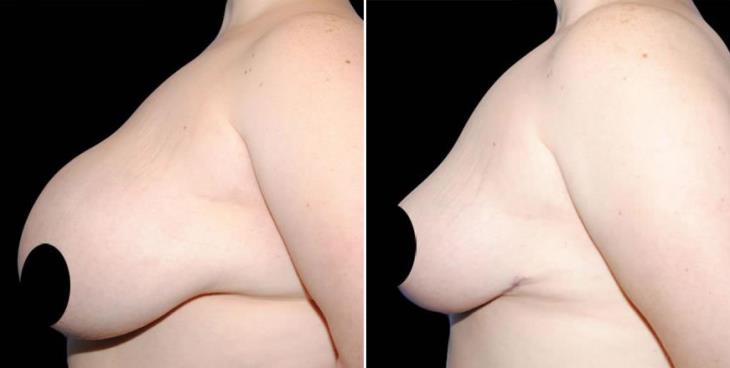 Breast Reduction Before And After Side View