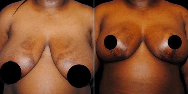 Before & After Breast Reduction