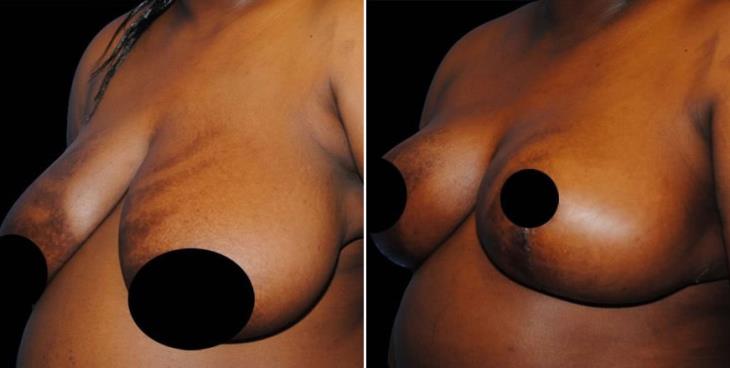 Before & After Breast Reduction Side View