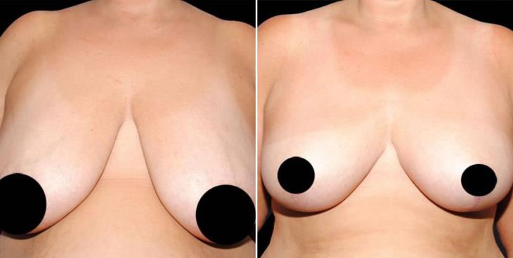 Breast Reduction Results Atlanta