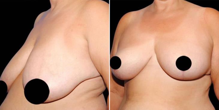 Breast Reduction Results Atlanta Side View