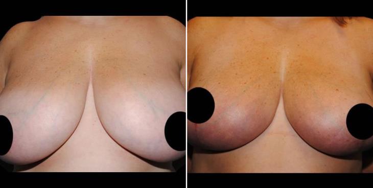 Breast Reduction Before & After