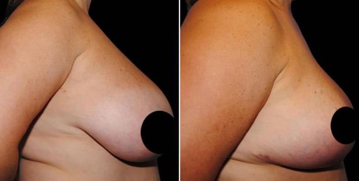 Breast Reduction Before & After Side View