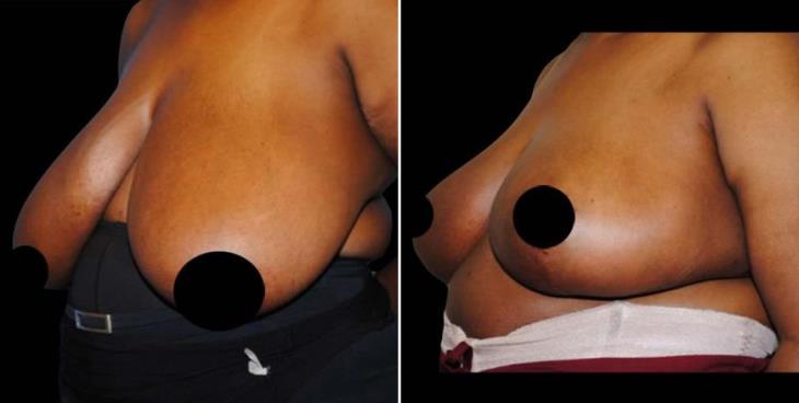 Before & After Breast Reduction Atlanta