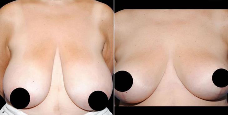 Atlanta Before & After Breast Reduction