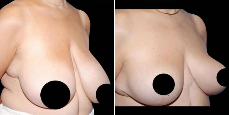 Atlanta Before & After Breast Reduction Side View