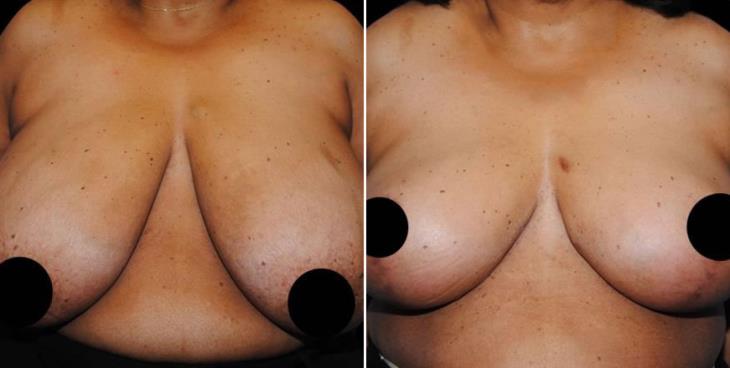 Reduction Mammoplasty Atlanta