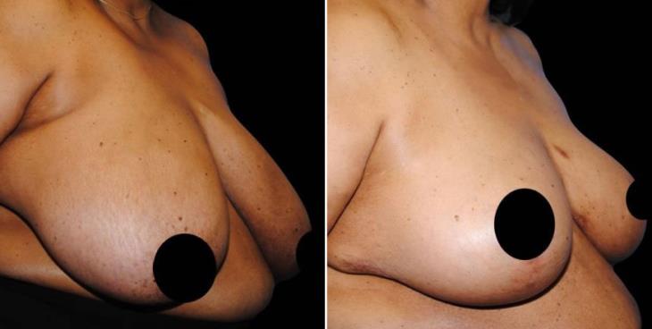 Reduction Mammoplasty Atlanta Side View