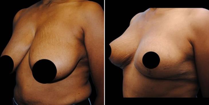 Atlanta Reduction Mammoplasty Side View
