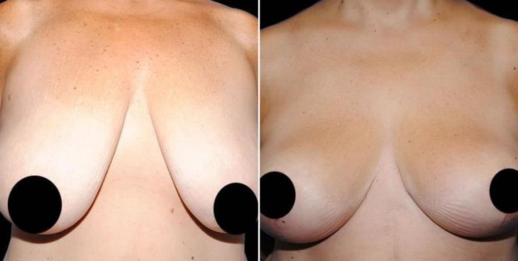 Reduction Mammoplasty Results Atlanta