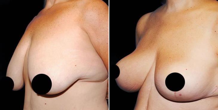Reduction Mammoplasty Results Atlanta Side View