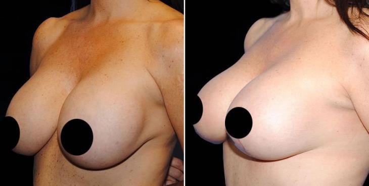 Before And After Breast Reduction In Marietta GA