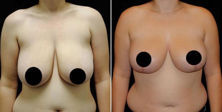 Reduction Mammoplasty Before And After