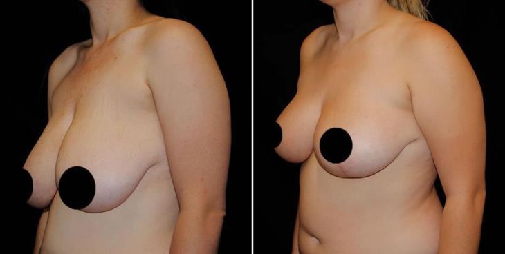 Reduction Mammoplasty Before And After Side View