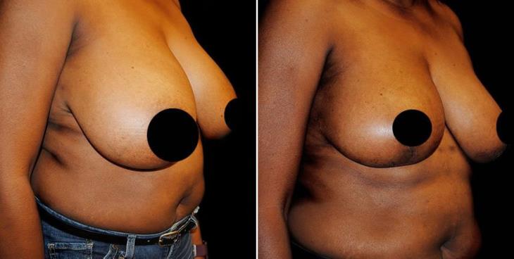 Atlanta Breast Reduction Results Side View