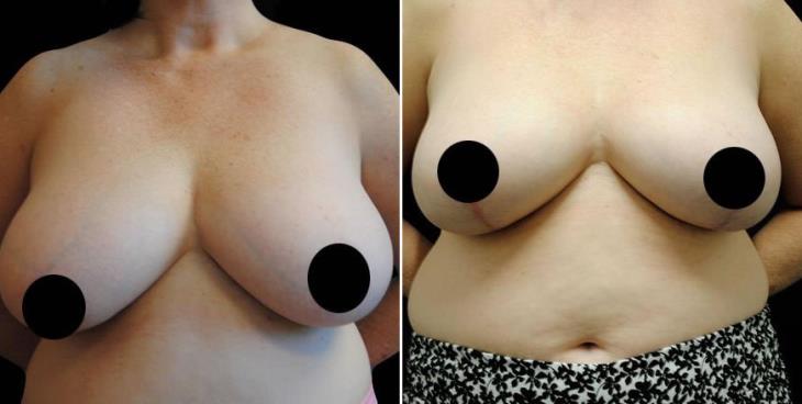 Before And After Reduction Mammoplasty