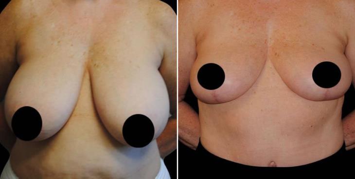 Reduction Mammoplasty Before & After