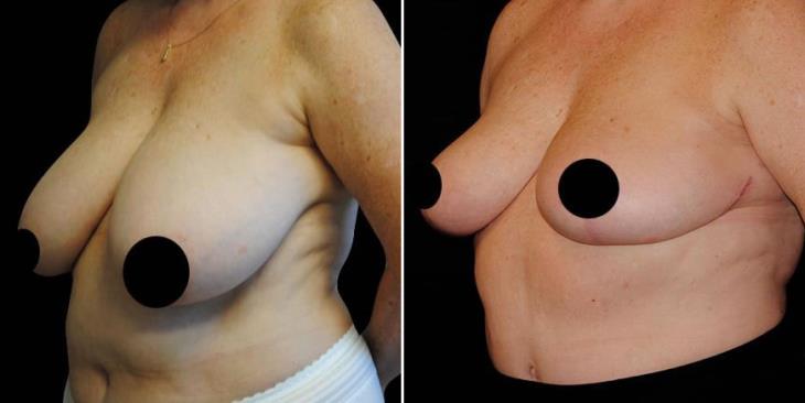 Reduction Mammoplasty Before & After Side View