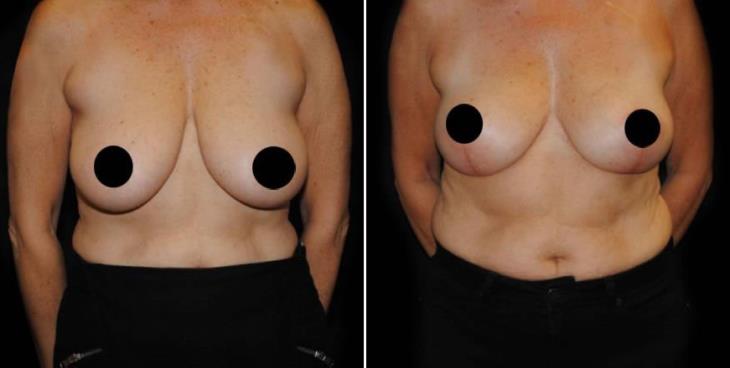 Before & After Reduction Mammoplasty