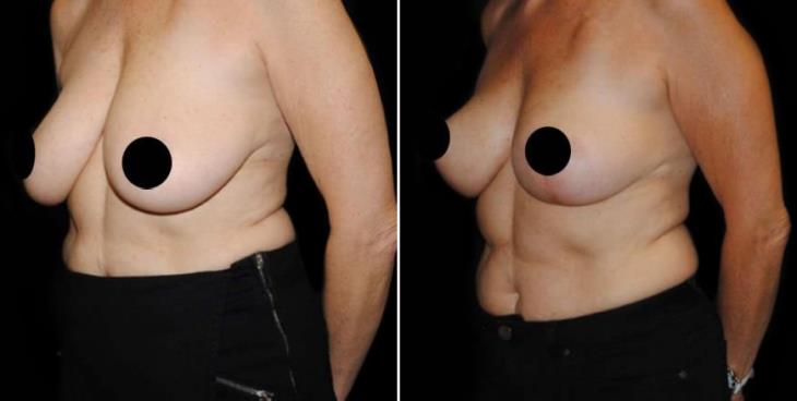 Before & After Reduction Mammoplasty ¾ View