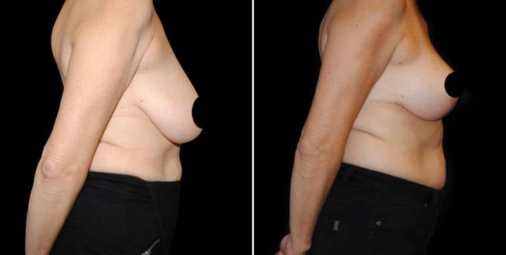 Before & After Reduction Mammoplasty Side View
