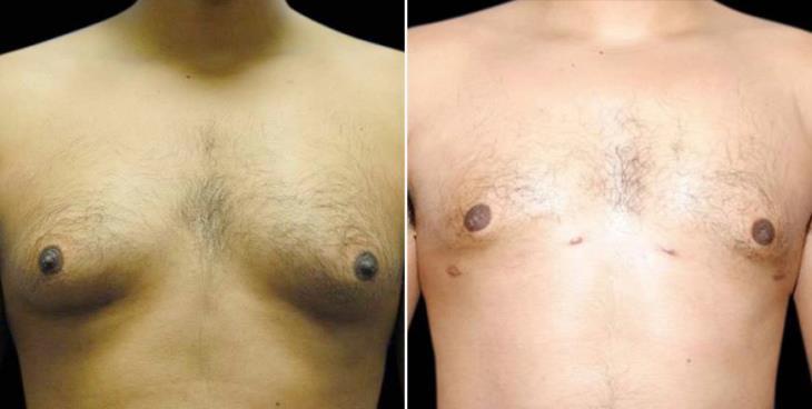 Gynecomastia Results Atlanta