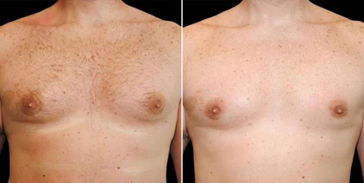 Male Breast Reduction Results