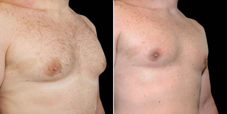 Atlanta Georgia Gynecomastia Surgery Results