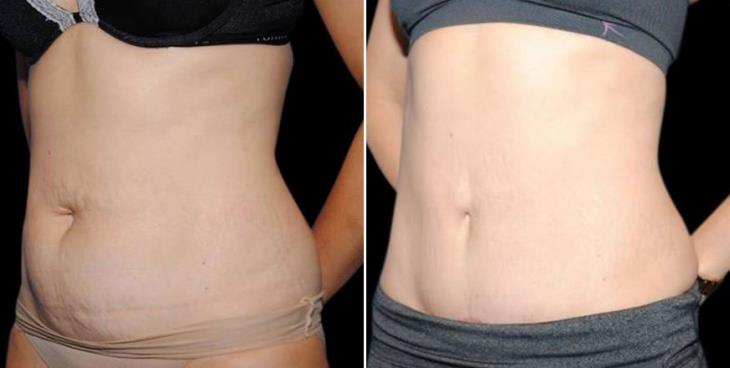 Liposuction Results Side View