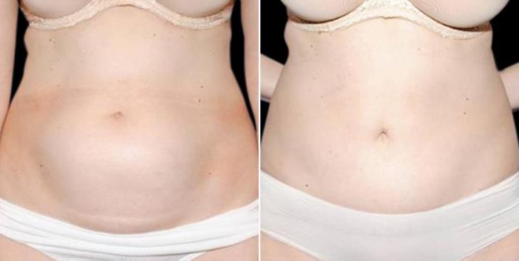 Lipo Results