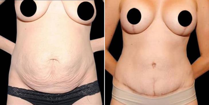 Liposuction Results Atlanta GA
