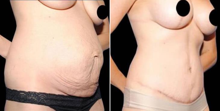 Liposuction Results Atlanta GA Side View
