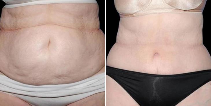 Atlanta GA Liposuction Results