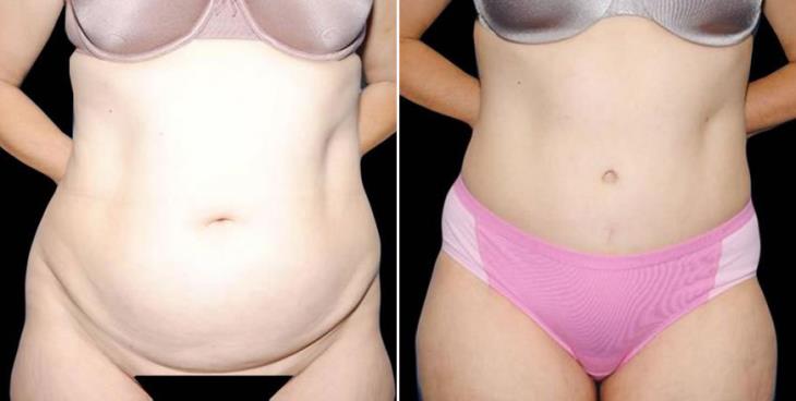 Atlanta Liposuction Results 