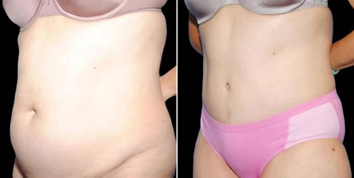 Atlanta Liposuction Results Side View