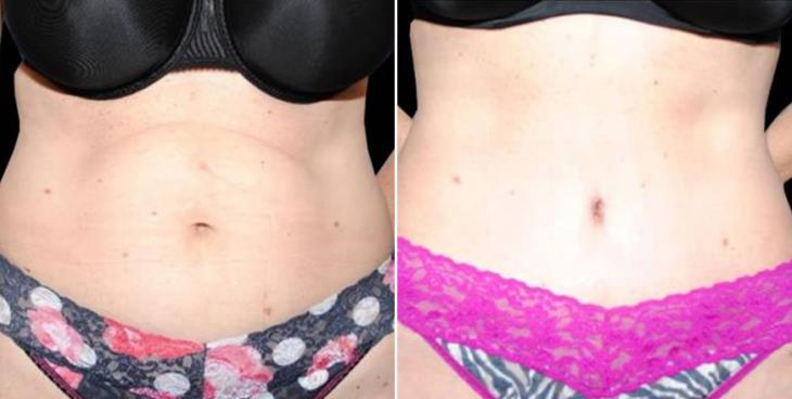 Before & After Lipo Atlanta