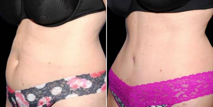 Before & After Lipo Atlanta Side View
