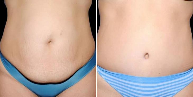 Atlanta Lipo Before & After