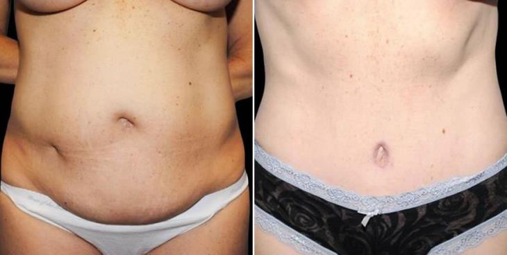 Before And After Atlanta Liposuction