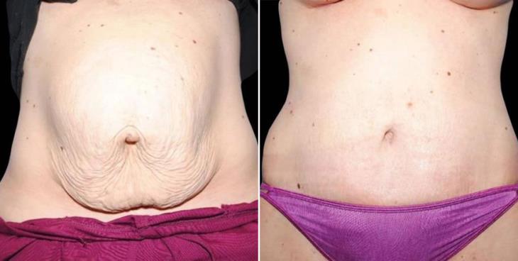 Before & After Atlanta Liposuction