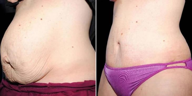Before & After Atlanta Liposuction Side View