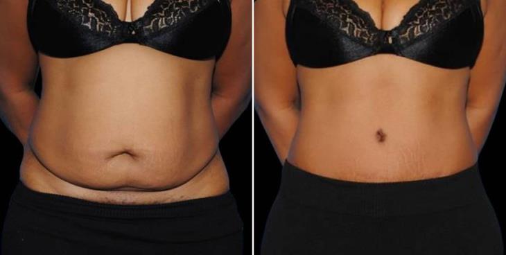 Atlanta Liposuction Before & After