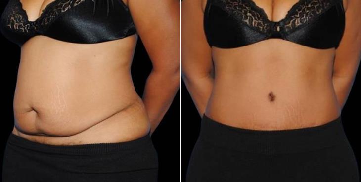 Atlanta Liposuction Before & After Side View